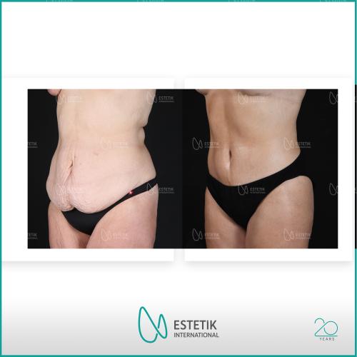 Abdominoplastie Photos avant & après